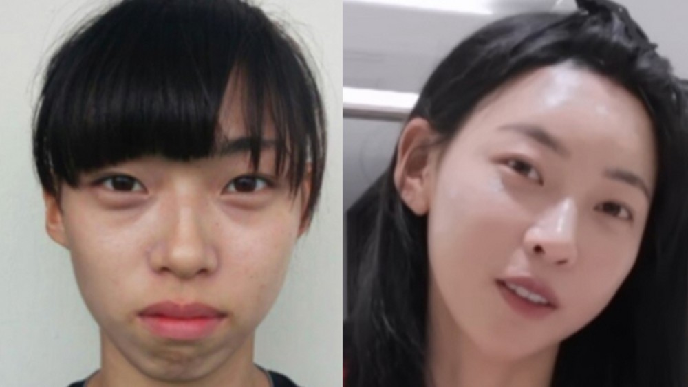 “생니 8개 뽑아”…’육상 카리나’ 김민지, 교정·시술 비포-애프터 공개→성형설 일축 [RE:뷰]